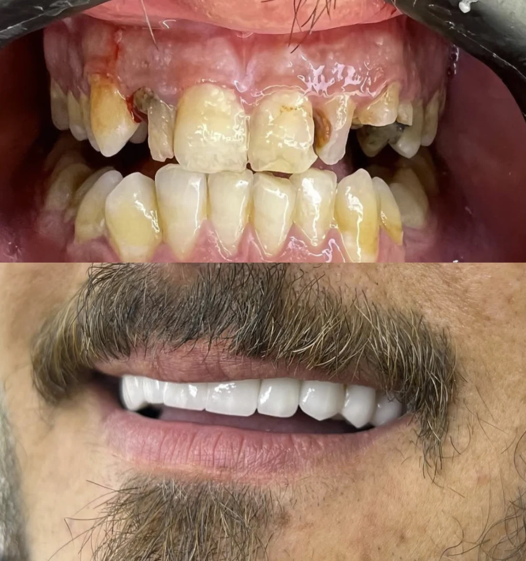 імплантація зубі , ціна