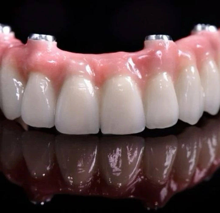 протез на імплантах