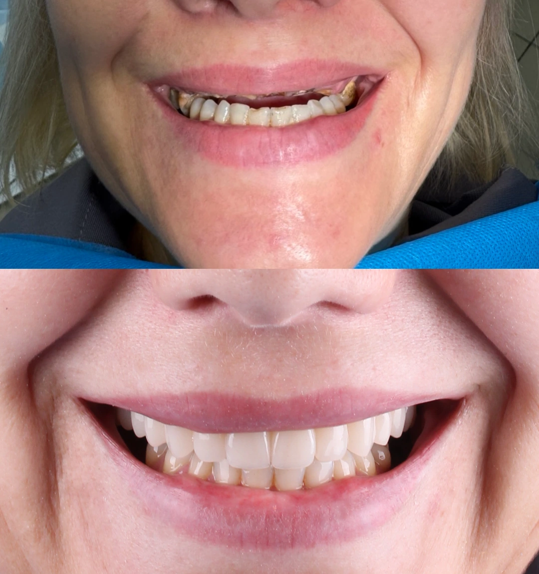 імплантація зубів повна