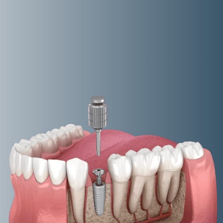 Імплантація одного зуба