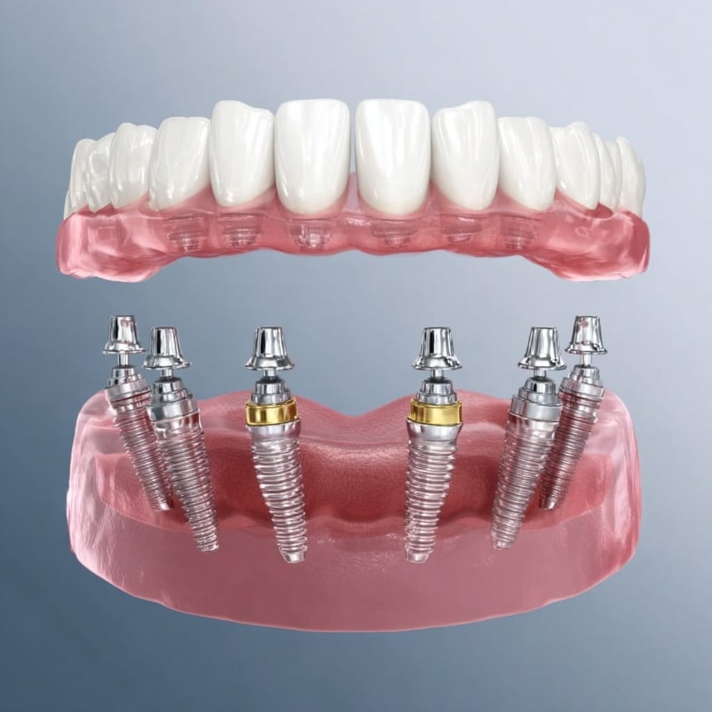 Імплантація Штрауман Київ