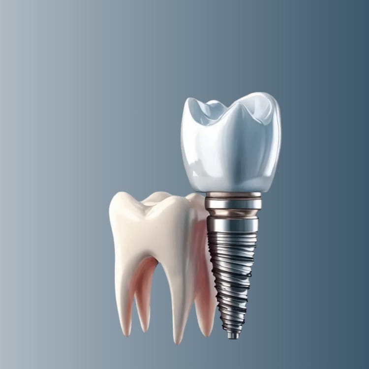 Імплантація одного зуба Корейські імпланти Мегаджен Київ