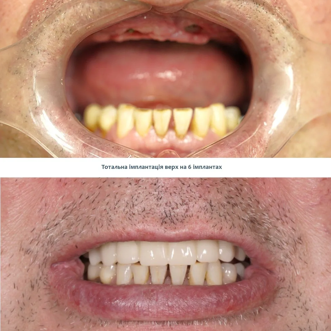 Тотальна імплантація за 7 днів Київ
