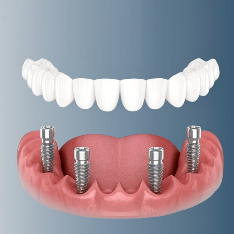 Тотальна Імплантація зубів