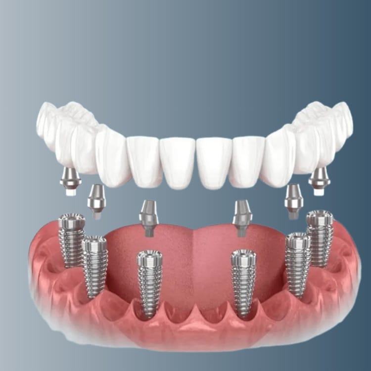 Імплантація зубів Голосієво