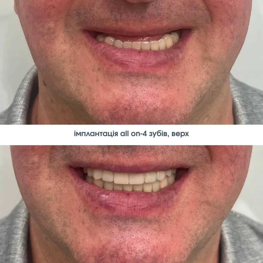 Імплантація зубів Штрауман ціна під ключ Київ