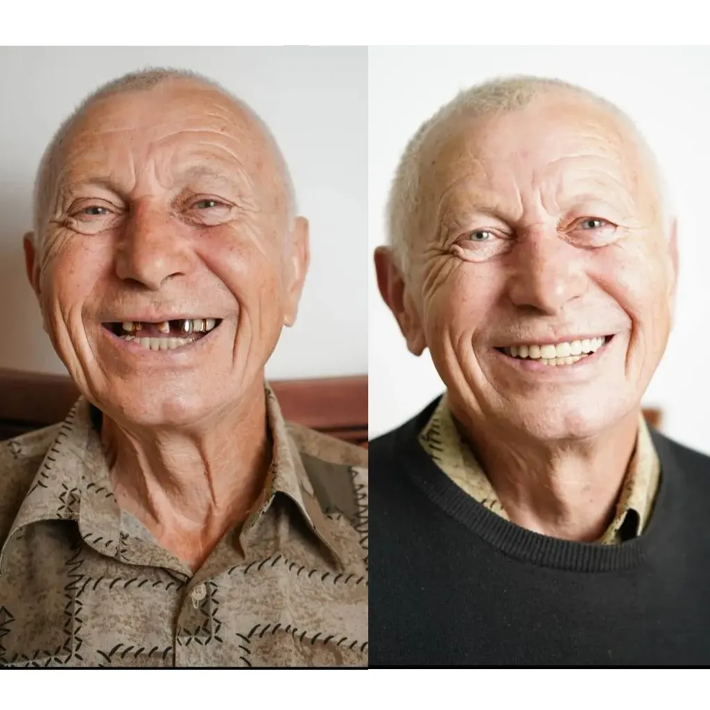 Імплантація зубів з а10 днів Киїів