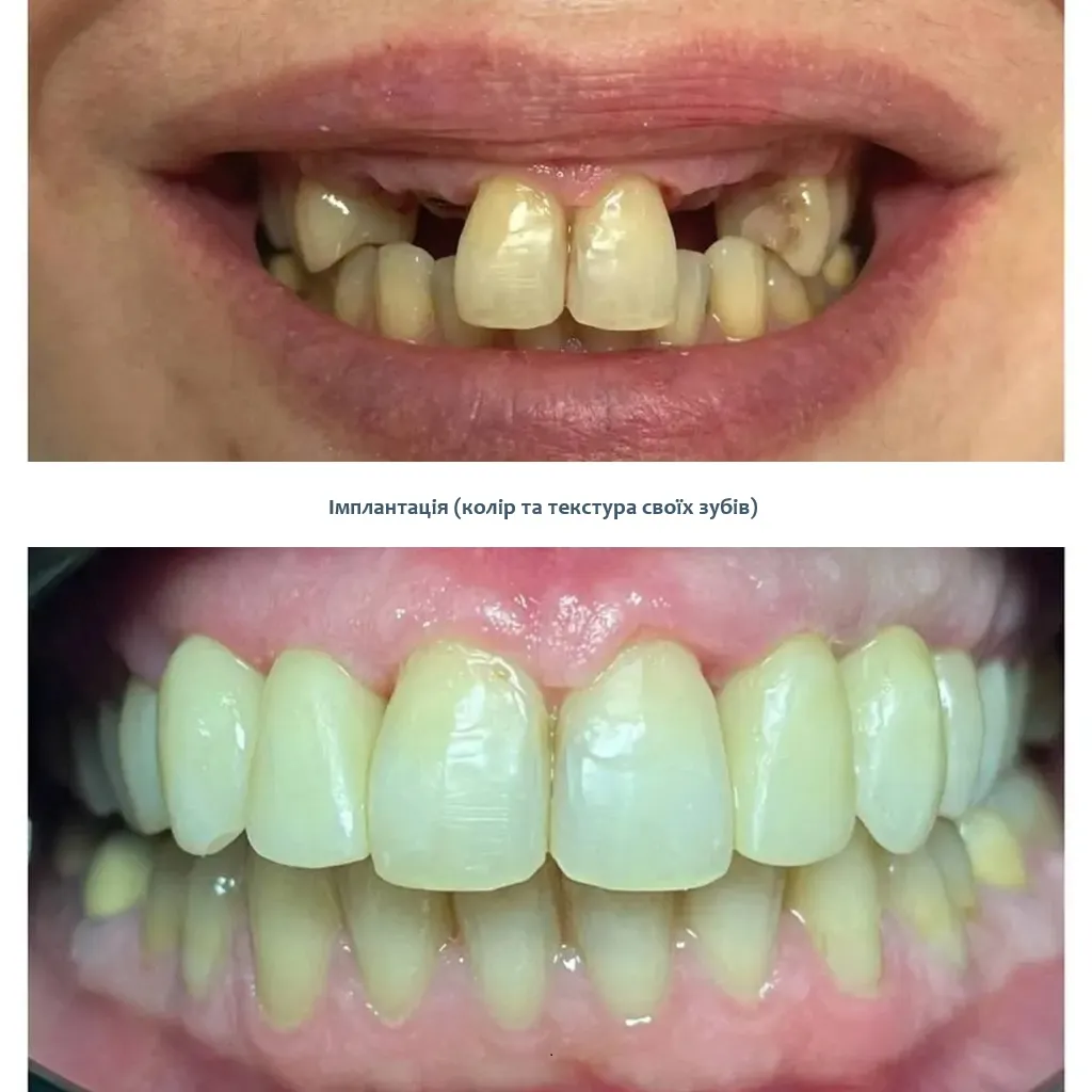 Заміна зубного моста Київ ціна