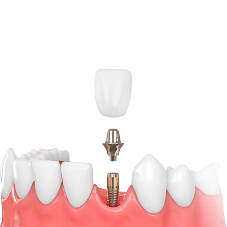 Імплнтація зуба Корейські імпланти ціна