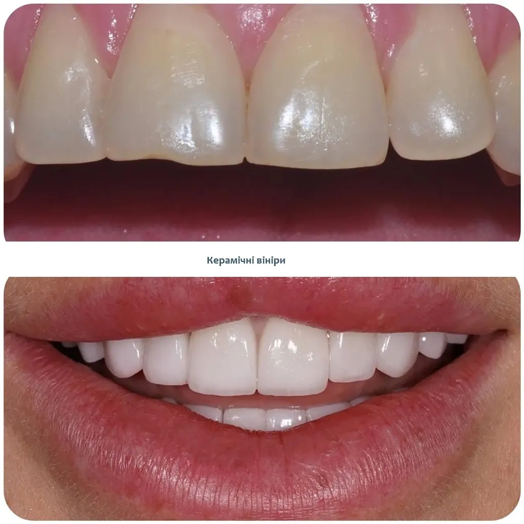 Керамічні вініри ціна Київ