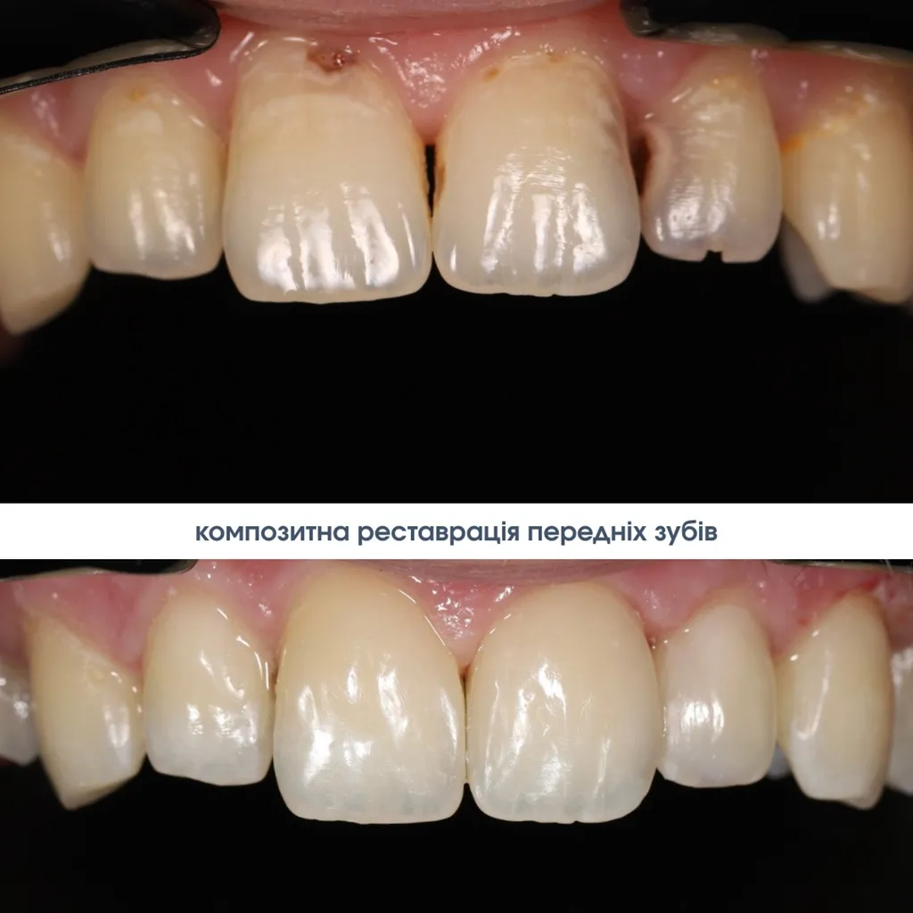 Художня реставрація зубів Солом'янка