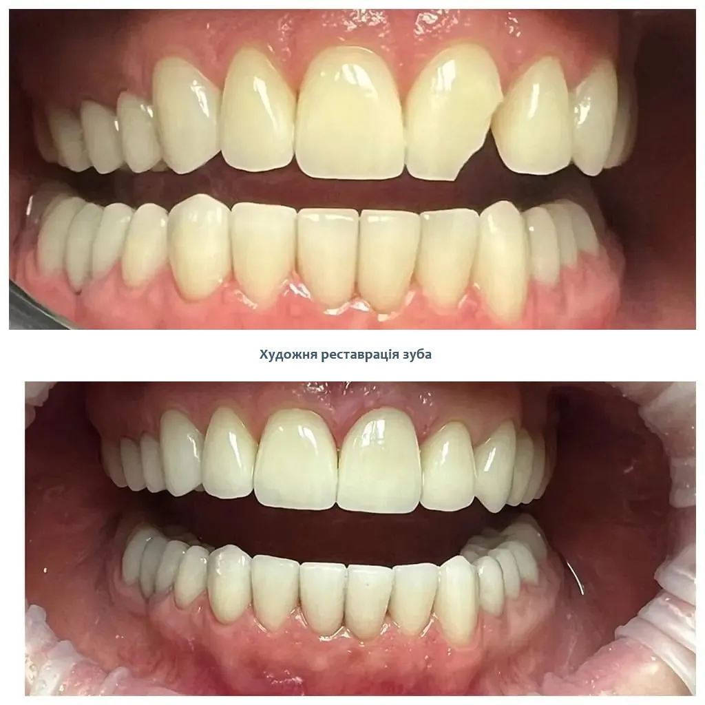 Композитні вініри Голосієво