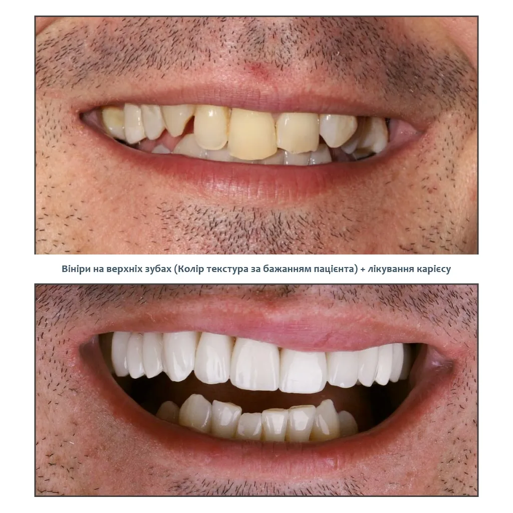 Лікування карієсу Солом'янка