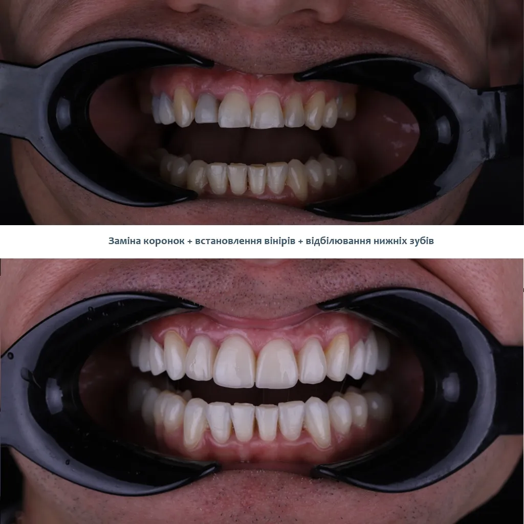 Лікування зубів під мікроскопом Київ