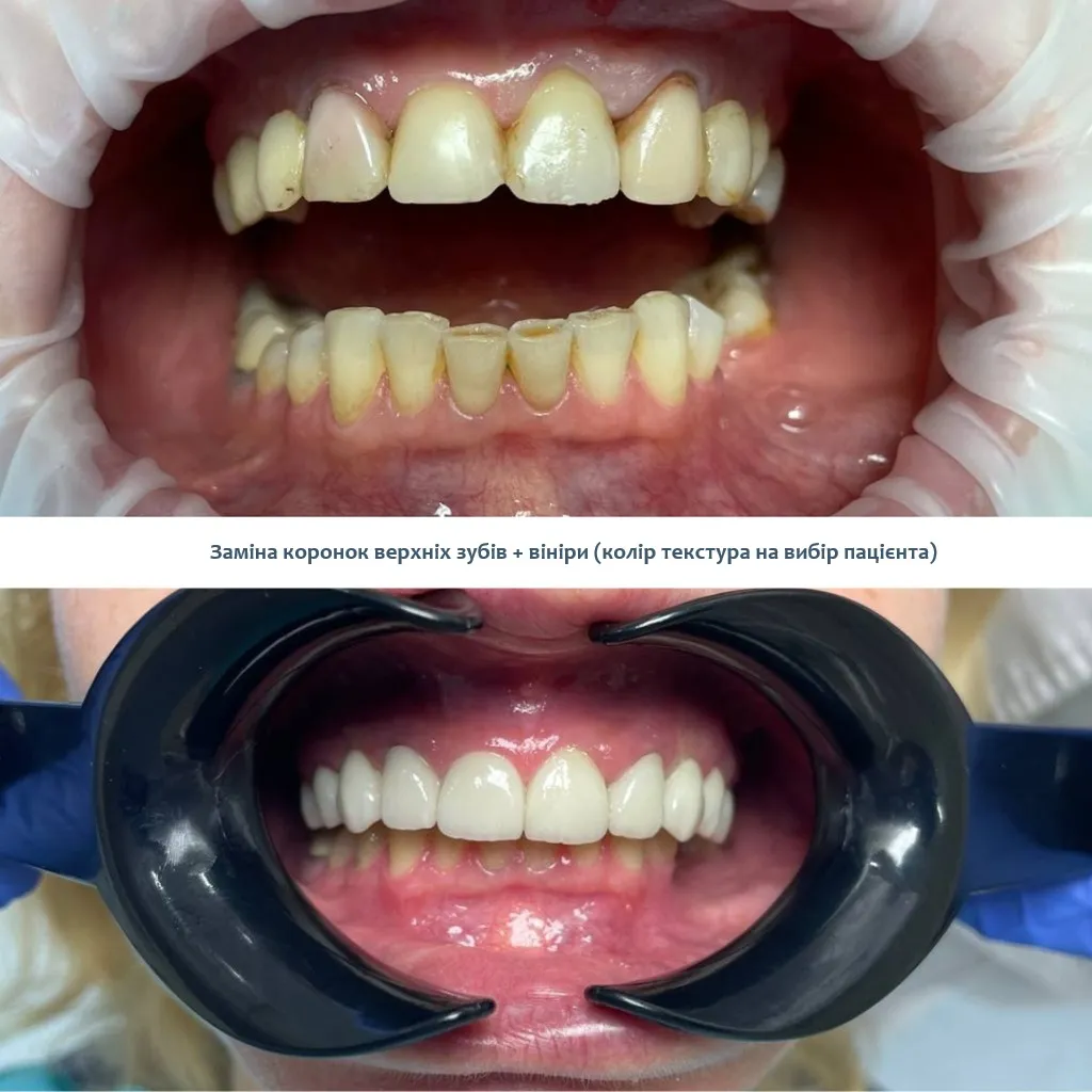 Керамічні брекети ціна Київ