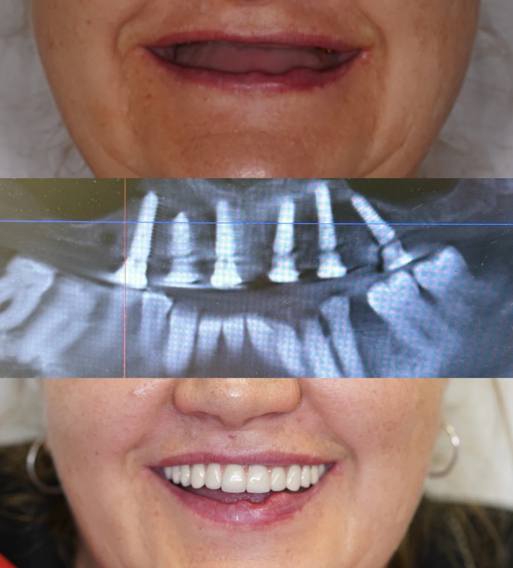 повна імплантація зубів коли відсутні всі зуби