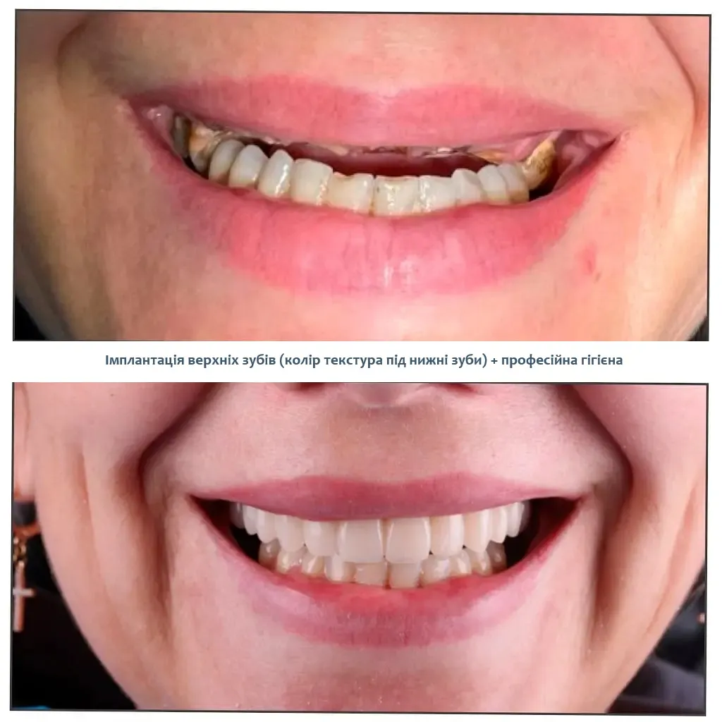 Імплантація зубів Солома