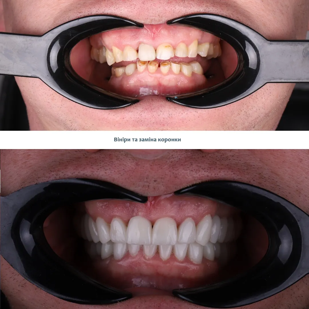 Лікування бруксизму Київ