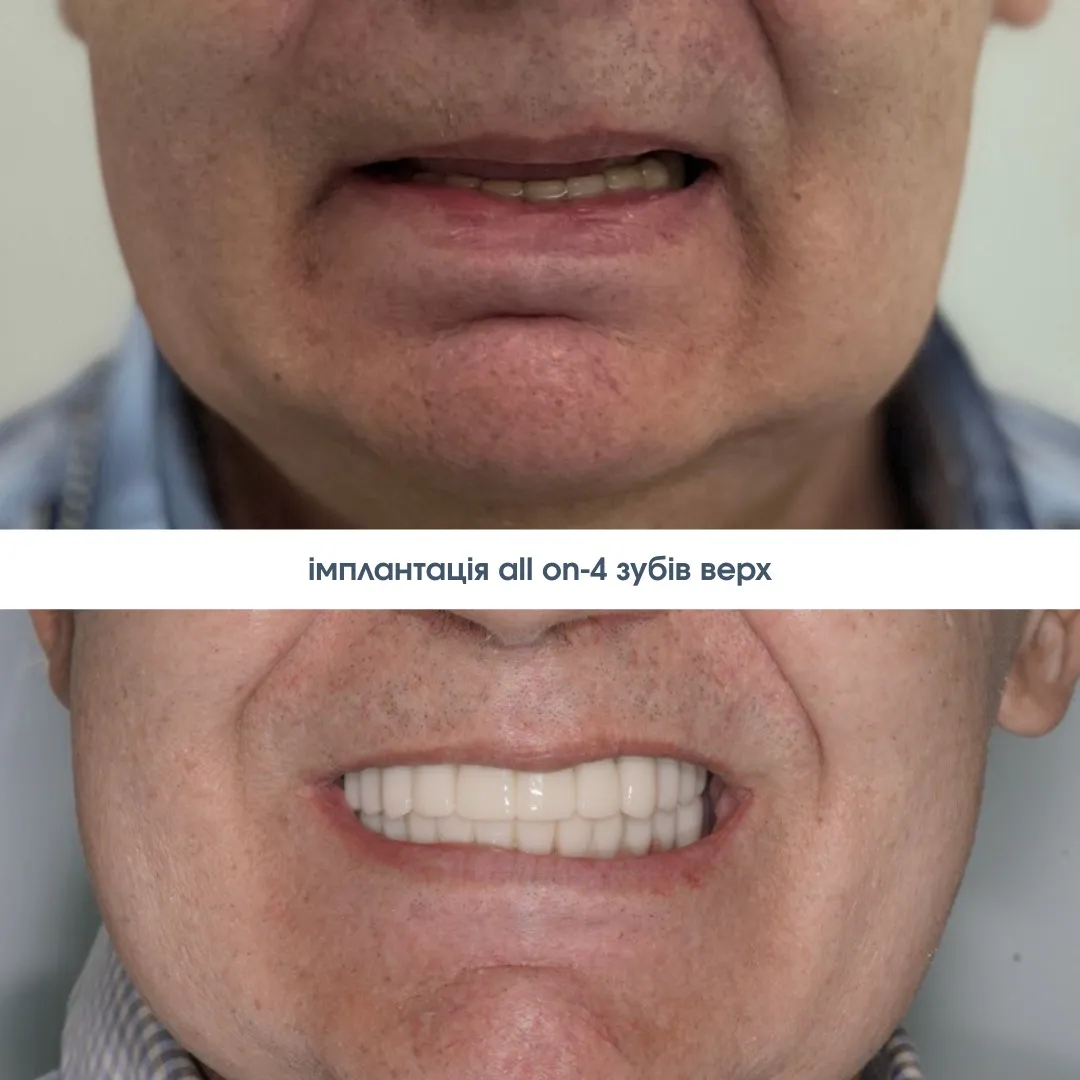 Імплантація Зубів Голосієво
