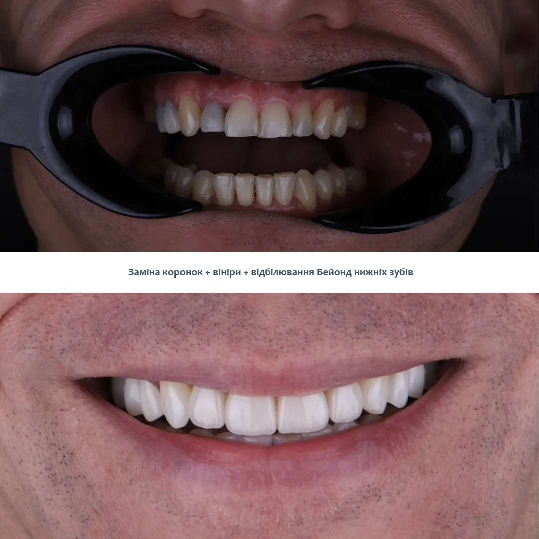 Заміна коронок ціна Солом' янка