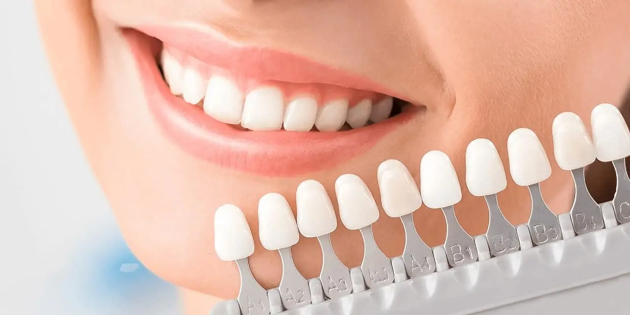 Відбілювання зубів Dentistman — Київ