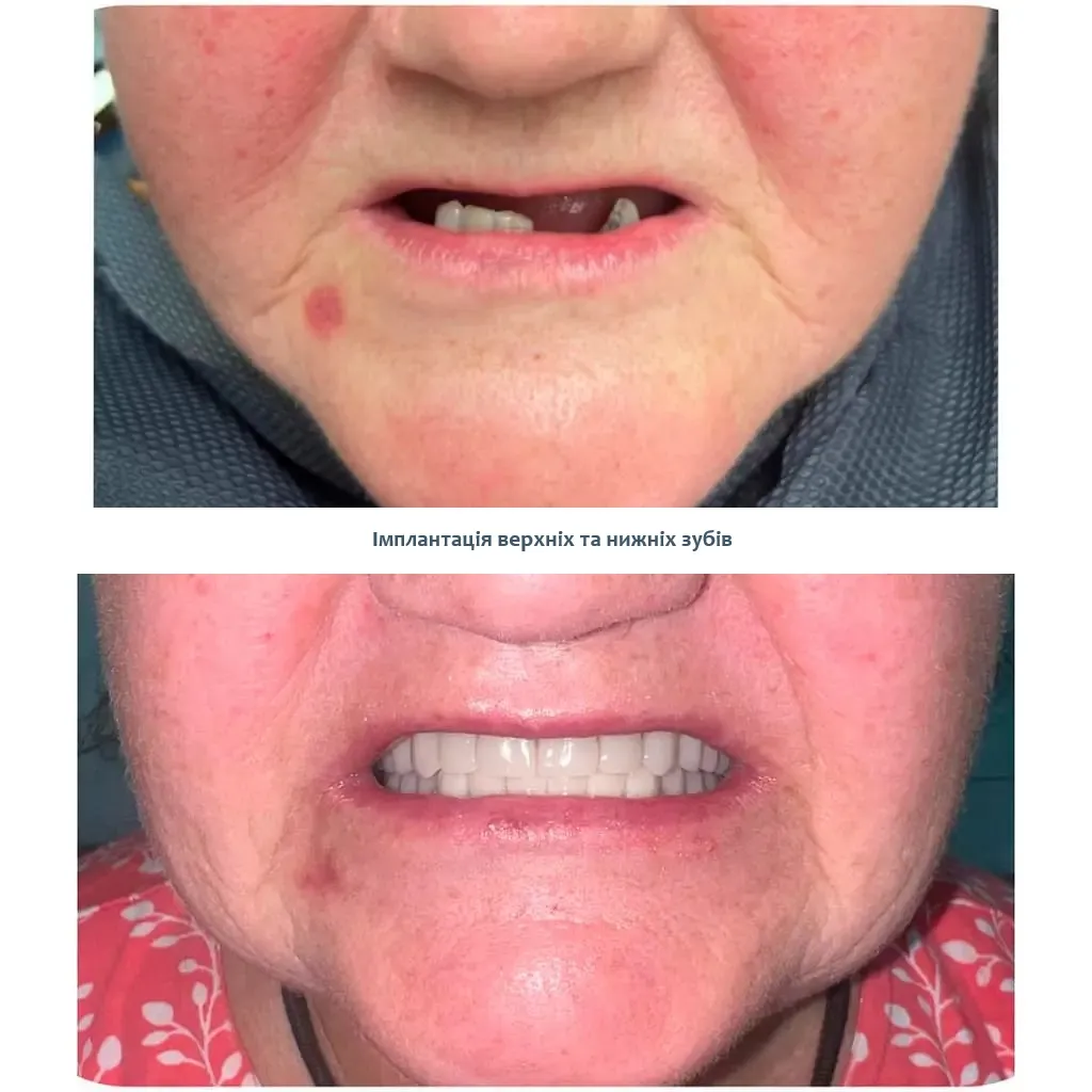 Повна імплантація зубів на 4 імплантах Київ