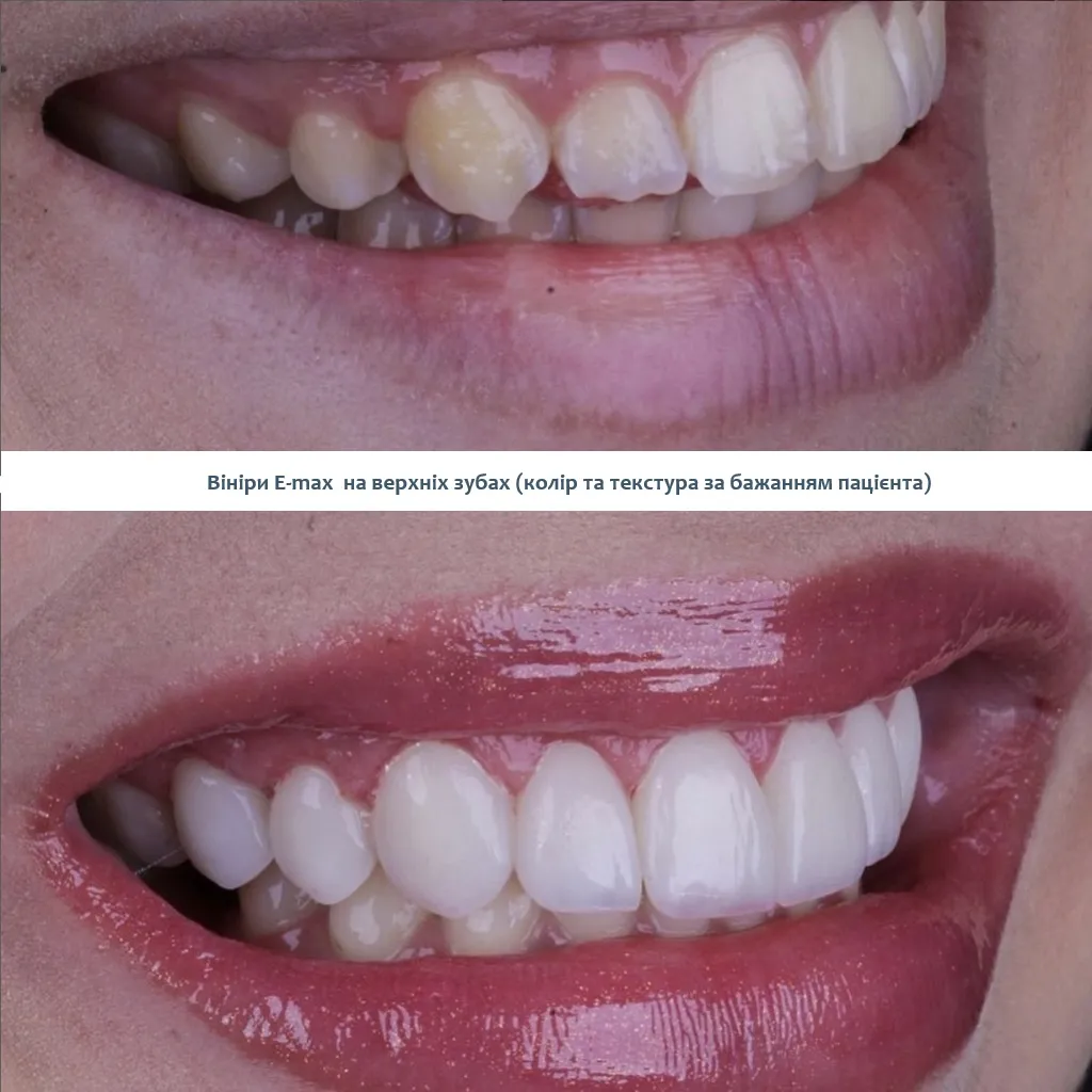 Керамічні вініри напівпрозорі Київ