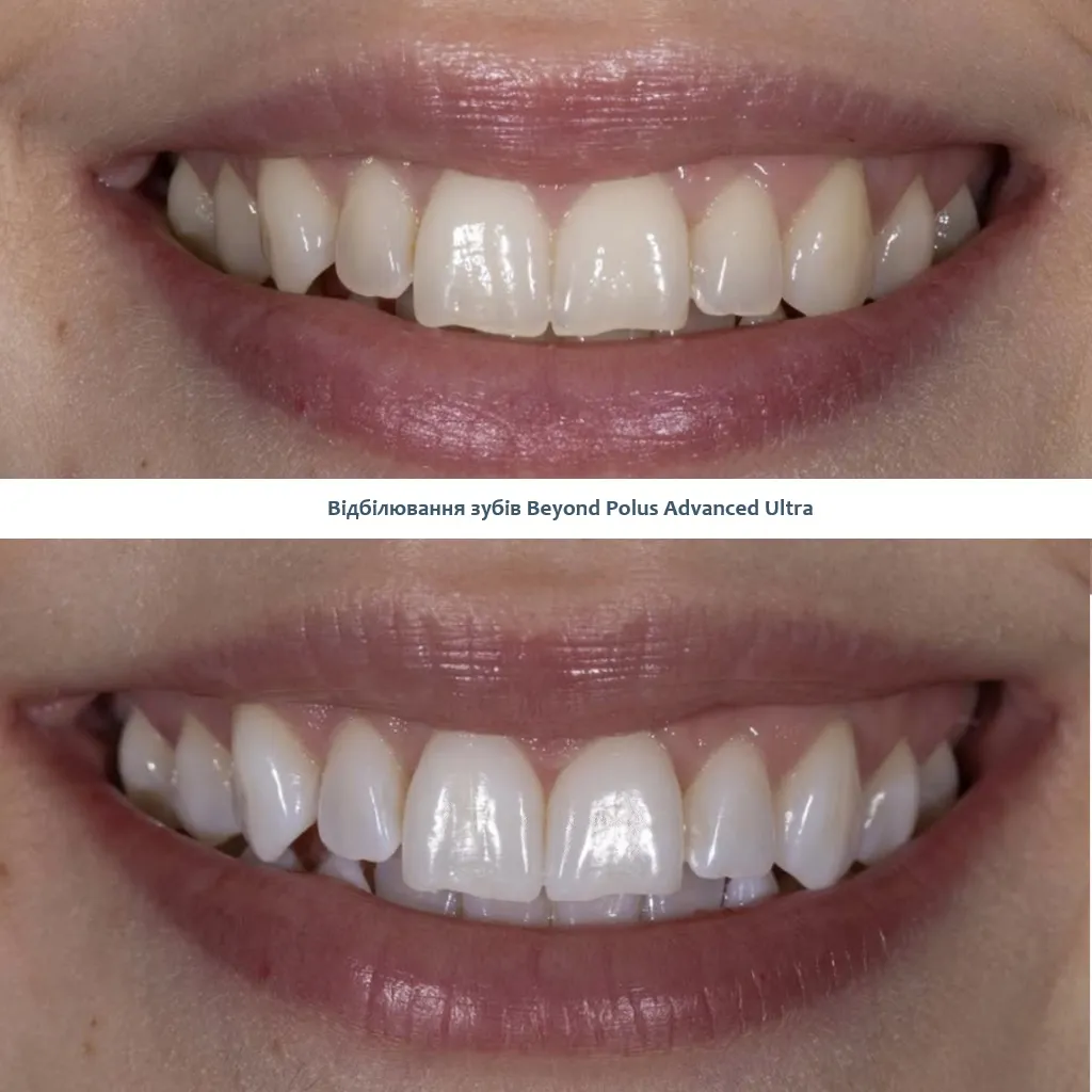 Відбілювання зубів Бейонд Голосієво