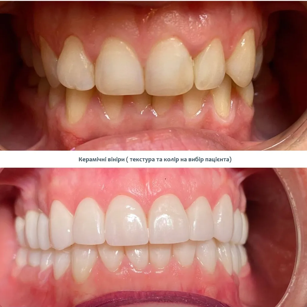 Angel Aligners елайнери ціна Київ