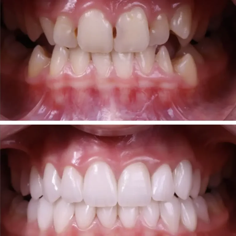 Брекети ціна Київ