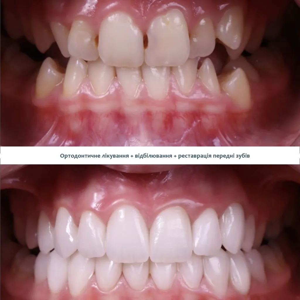 Вирівнювання зубів Елайнерами Київ