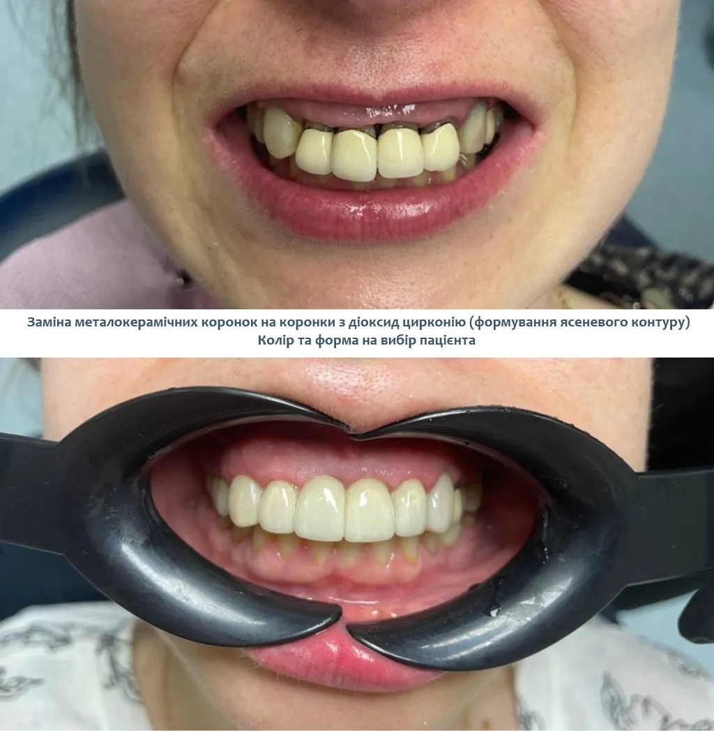 Встановлення коронки цирконій Голосієво