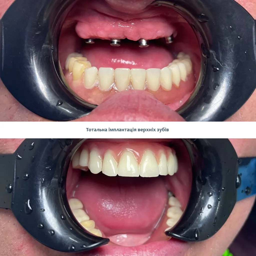 Тотальна імплантація зубів ціна Київ