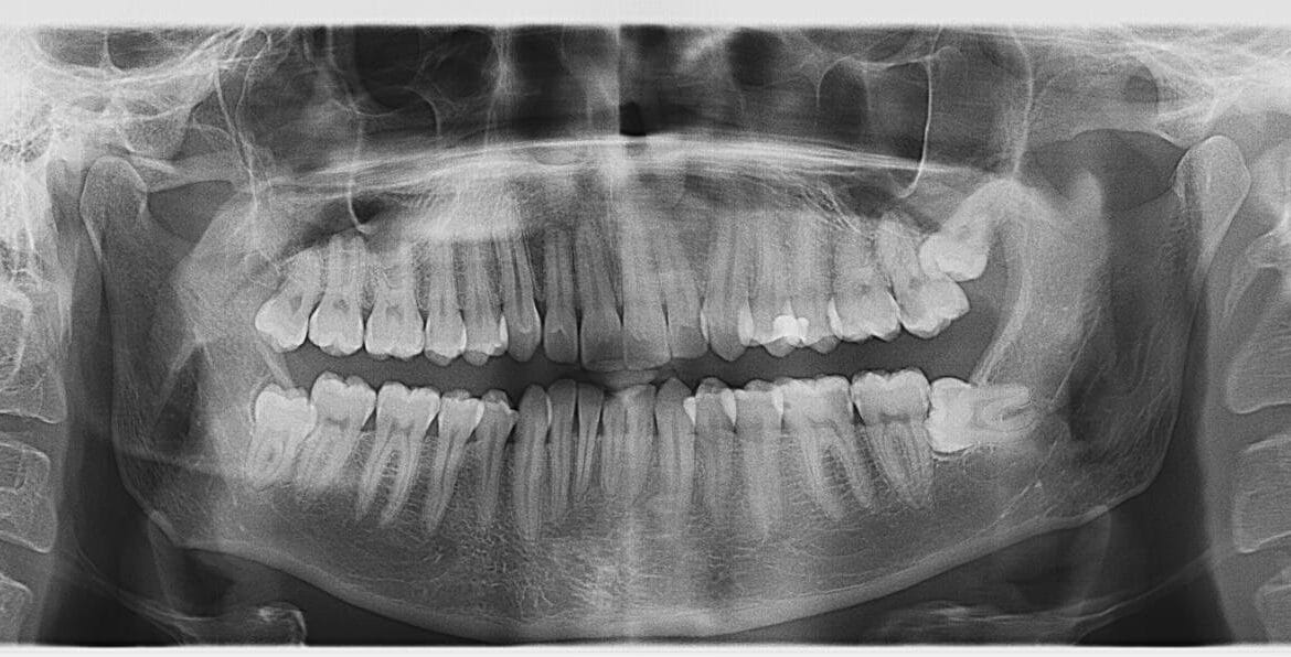 видалення зуба мудрості