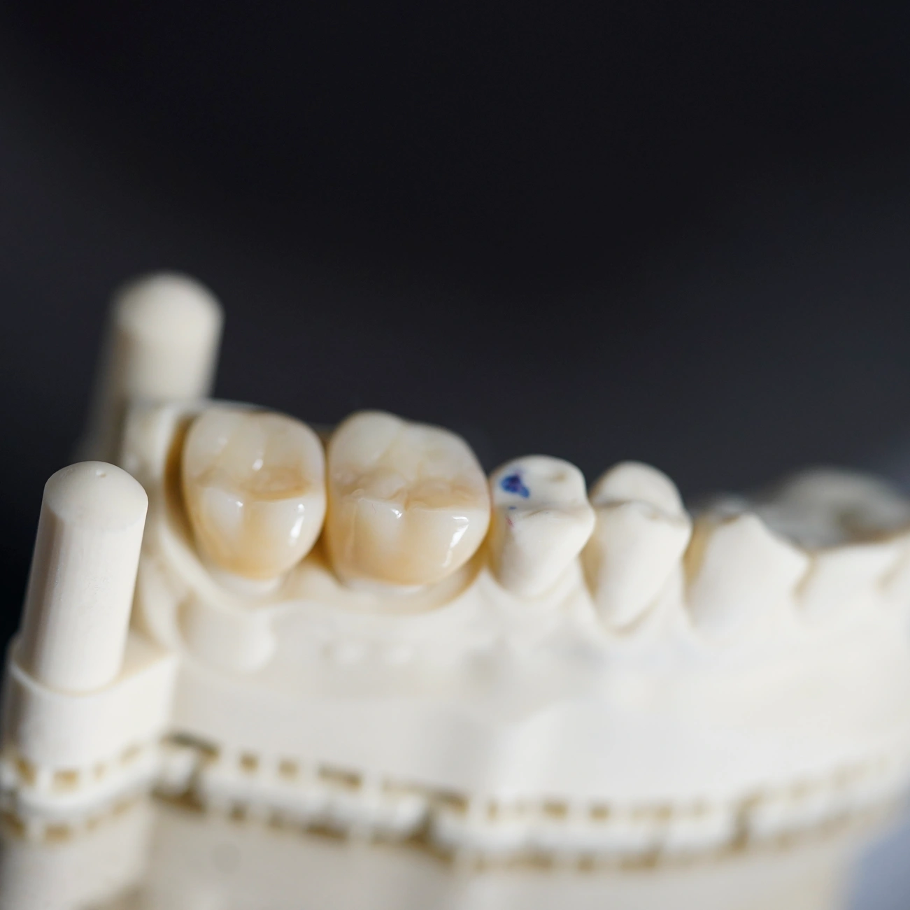 ціна керамічної коронки київ Голосієво