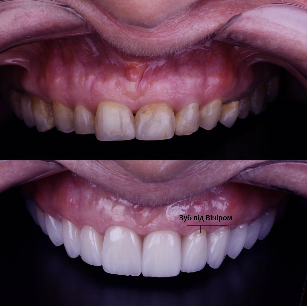 ціна керамічних вінірів Голосієво київ