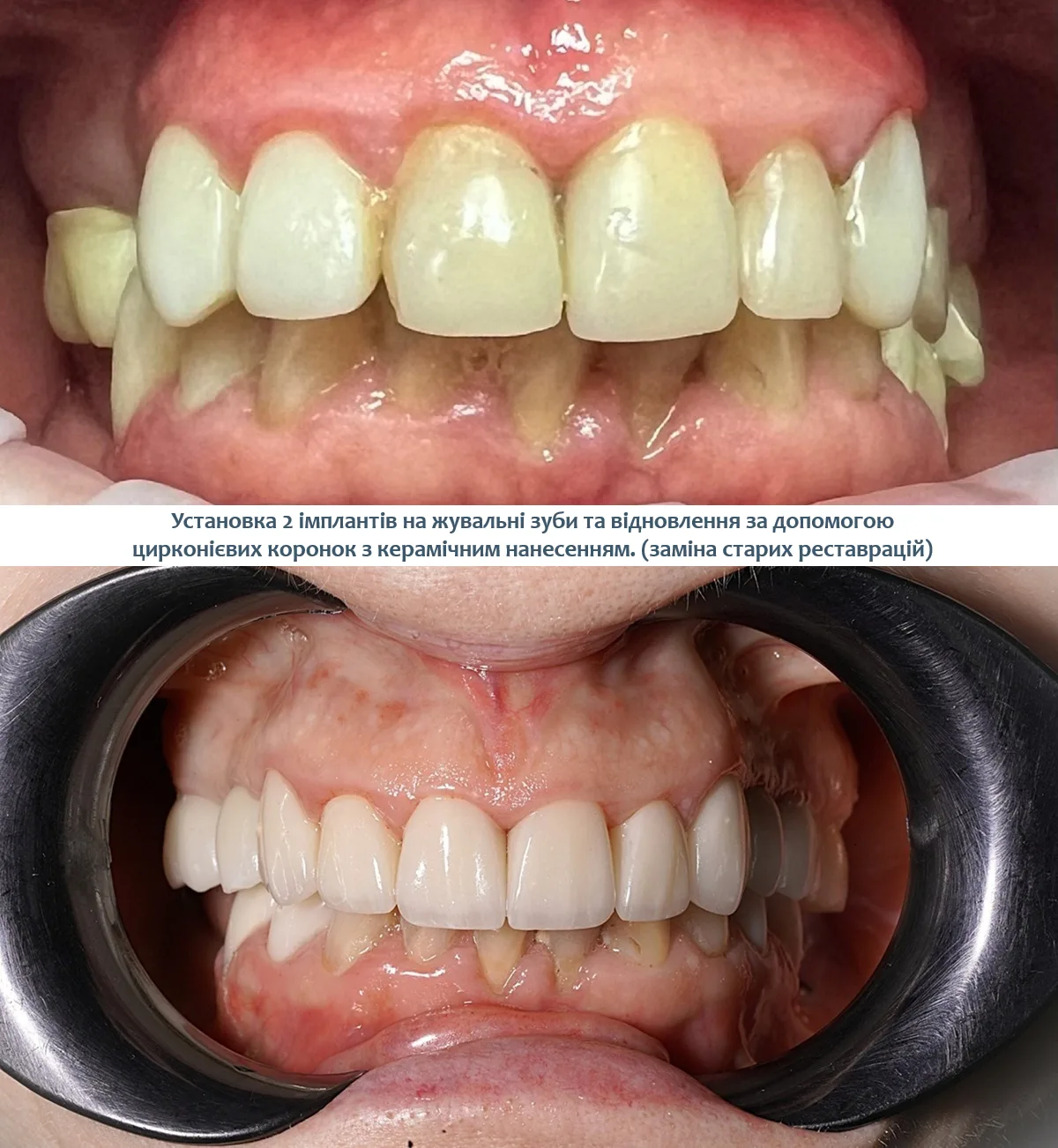 протезування зубів фото до та після