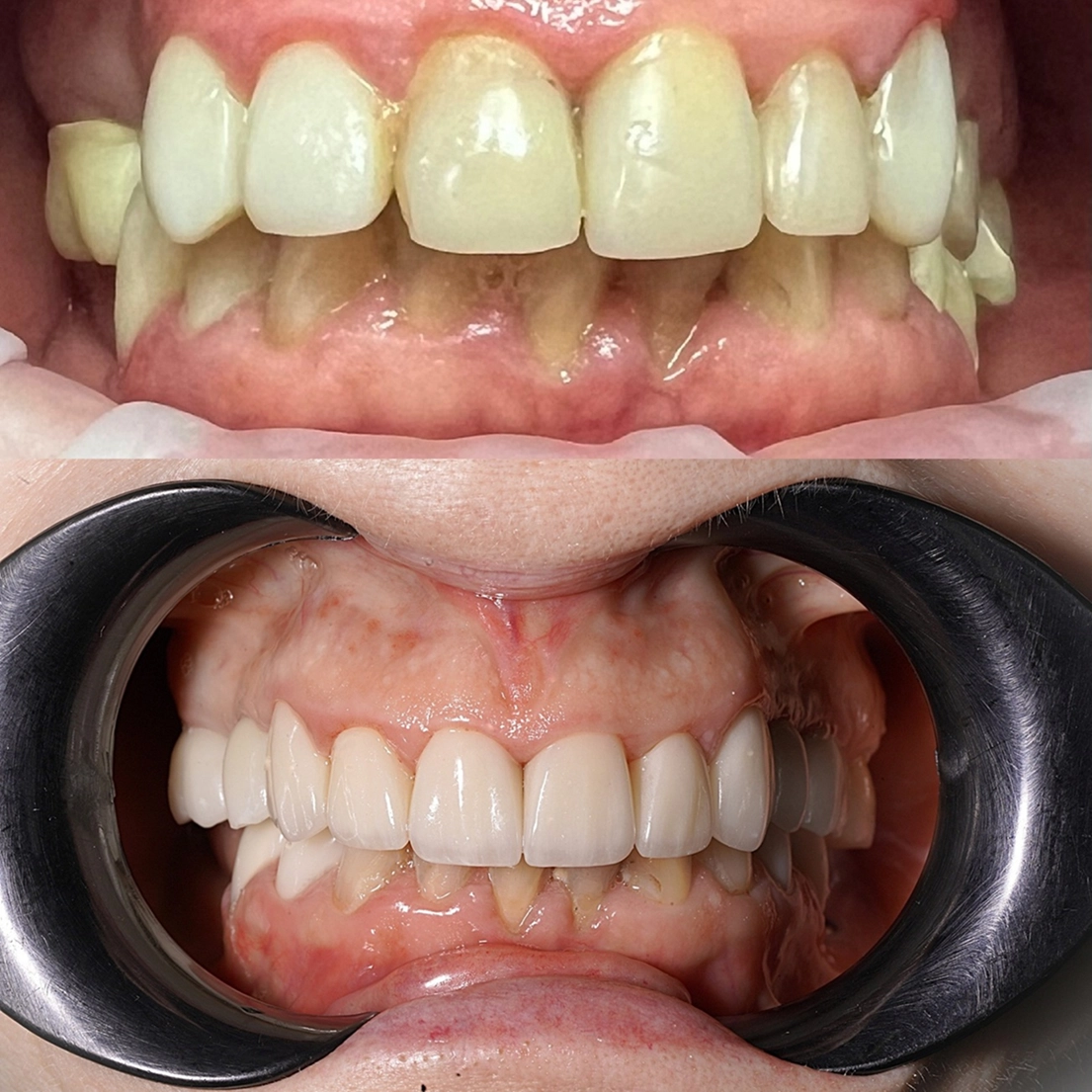 фото керамічної коронки високої якості київ