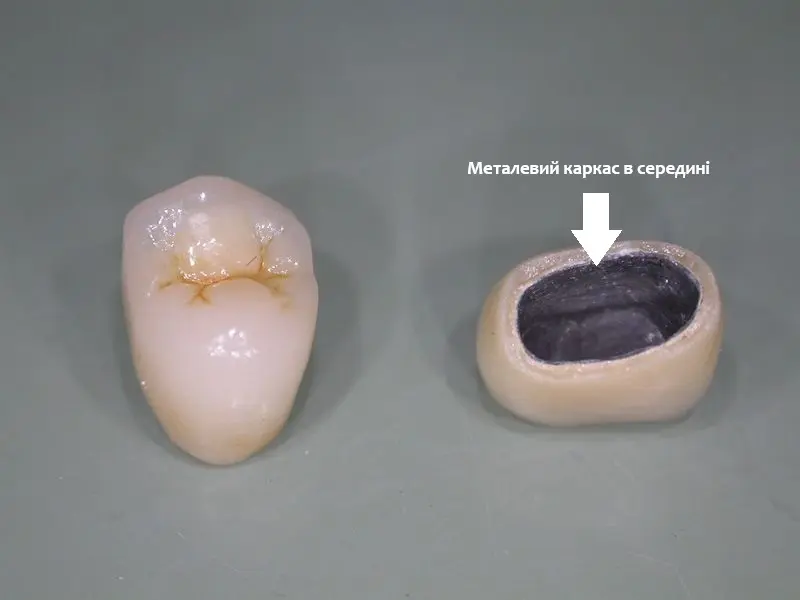 Металокерамічна коронка та її особливості