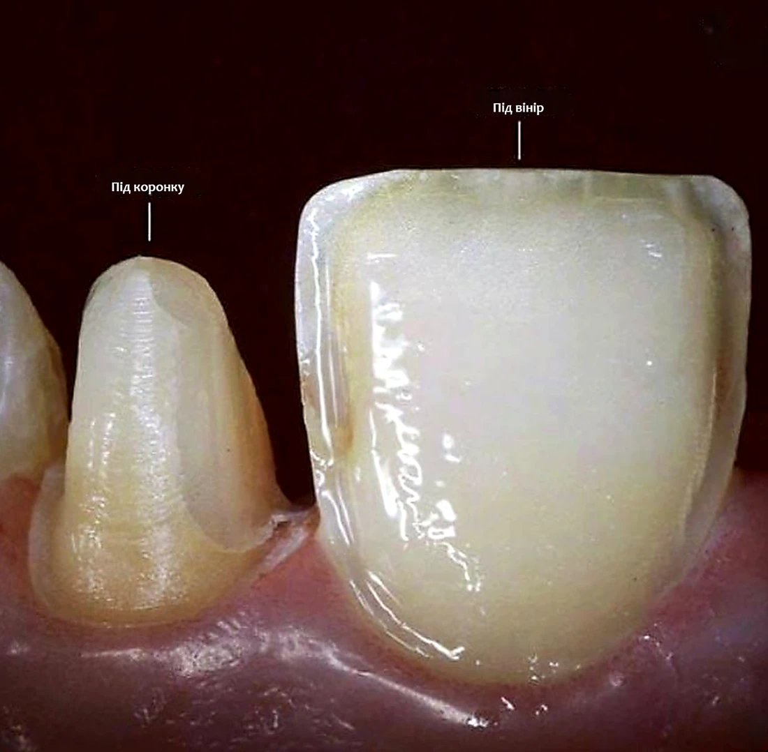 скільки обточується зуб під вініри київ