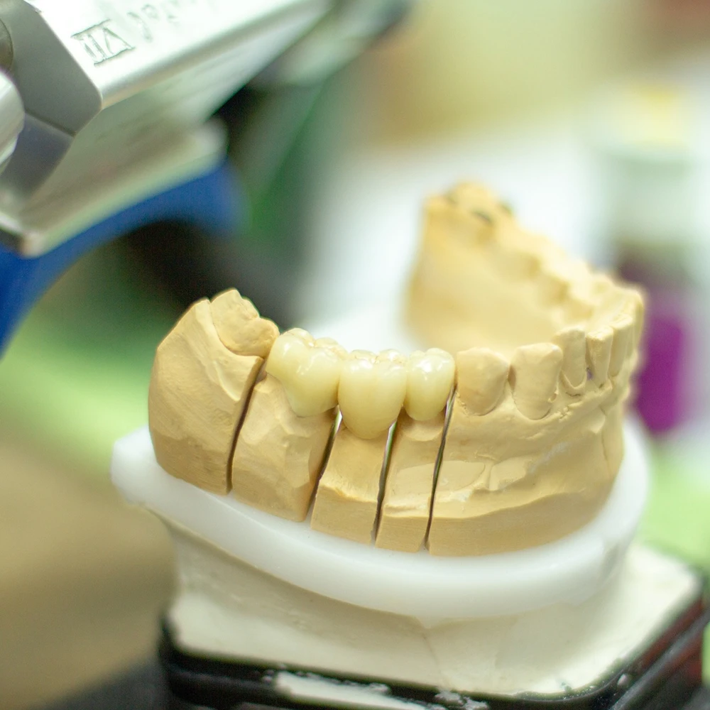 які коронки на зуби краще ставити