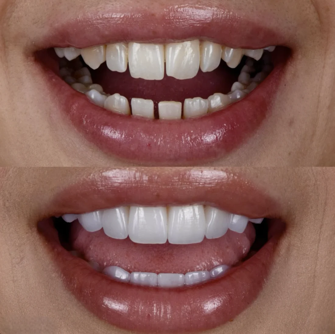 які вініри кращі ціна київ